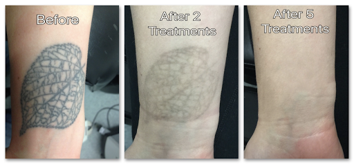 Explore tattoo ideas for moms with a son, creative tattoo ideas in Honolulu, available at Removery Tattoo Removal & Fading