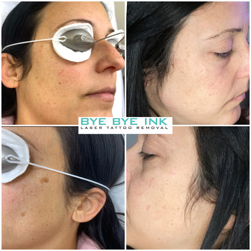 Explore blackout tattoo cover up ideas, creative tattoo ideas in Middle Village, available at Bye Bye Ink Laser Tattoo Removal