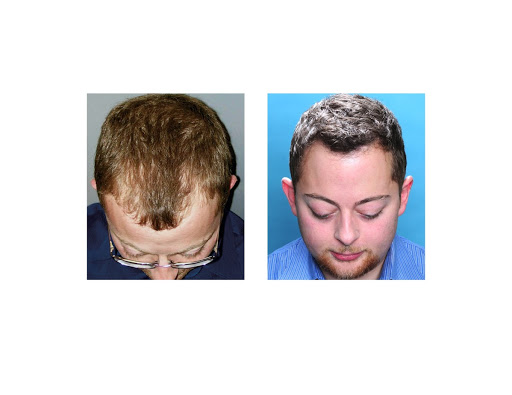 Hair Transplantation Clinic «Bosley Medical - Atlanta», reviews and photos, 3379 Peachtree Rd NE #800, Atlanta, GA 30326, USA