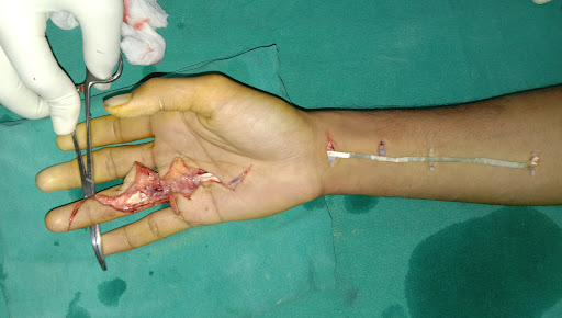 Dr. Vinit Arora, Best Hand Surgery Specialist Jaipur