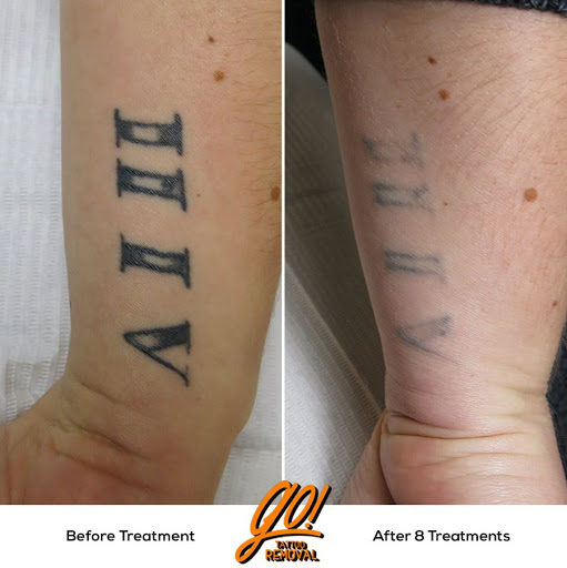 Explore naked women tattoo ideas, creative tattoo ideas in Allentown, available at Removery Tattoo Removal & Fading