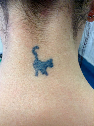 Tattoo removal clinics Milton Keynes