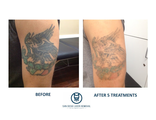 Explore massachusetts tattoo ideas, creative tattoo ideas in San Diego, available at Removery Tattoo Removal & Fading