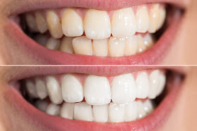 London Teeth Whitening