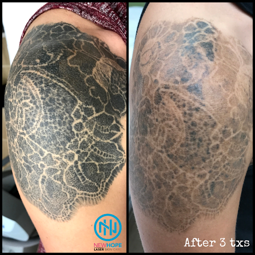 Explore idaho tattoo ideas, creative tattoo ideas in Westminster, available at Newhope Laser Skin Care