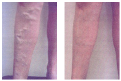 Find ideas for tattoo wedding rings for your next unique tattoo in Sterling Heights at Skin & Vein Center