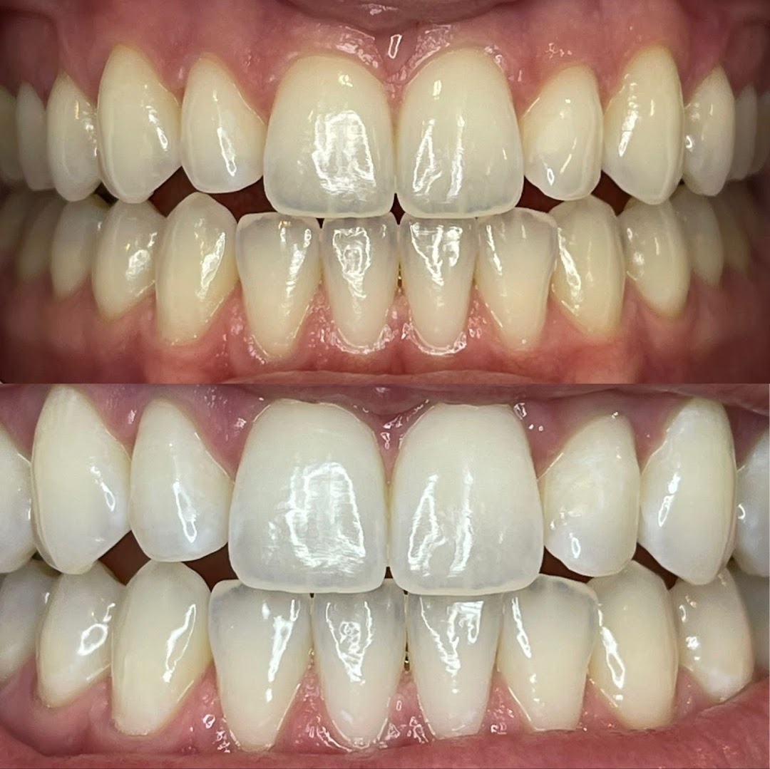 Organically White Teeth Whitening