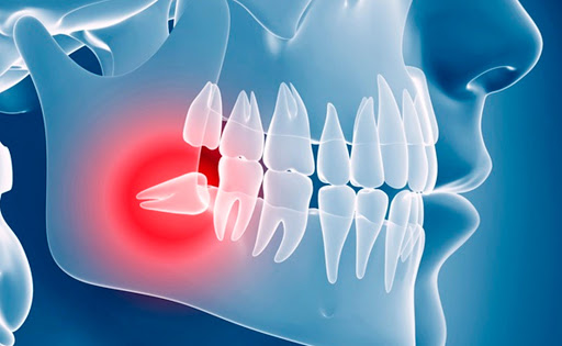Implantes Dentales Ecuador