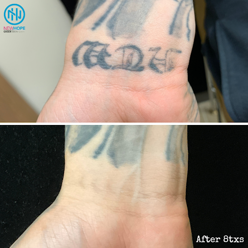 Explore tattoo ideas for women arm, creative tattoo ideas in Westminster, available at Newhope Laser Skin Care