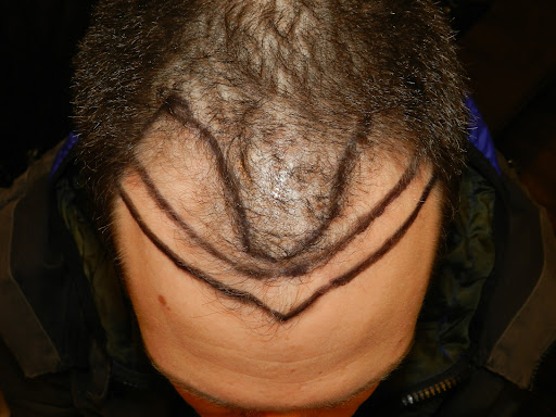 Hair Replacement Service «Medical Hair Transplant & Aesthetics», reviews and photos, 490 Post St #1701, San Francisco, CA 94102, USA