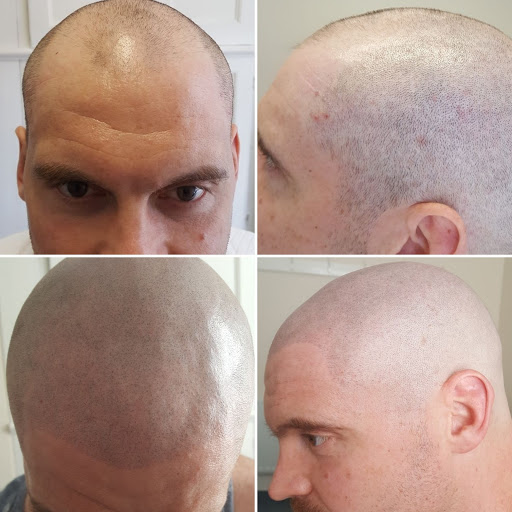 Redeem Microblading & Scalp micropigmentation, Leeds