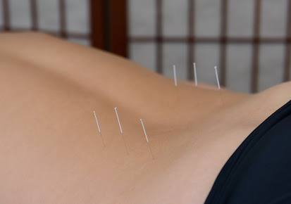 ليزا لي الوخز بالإبر - Lisa Lee Acupuncture