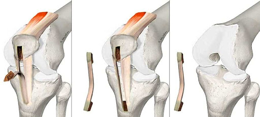 Spécialiste des ligaments croisés antérieurs et postérieurs - Paris - Genou