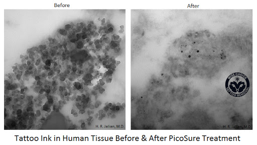 Explore party tattoo ideas, creative tattoo ideas in Denver, available at Wise Choice Tattoo Removal