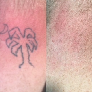 Explore fire and air tattoo ideas, creative tattoo ideas in Winter Park, available at Winter Park Tattoo Removal