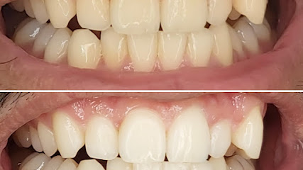 Schnee Zähne (Zahnaufhellung)