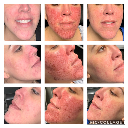 Explore ironman triathlon tattoo ideas, creative tattoo ideas in Lake Dallas, available at Restore YOUth Med Spa