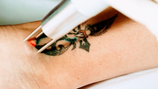 UNBRANDED Austin - Laser Tattoo Removal