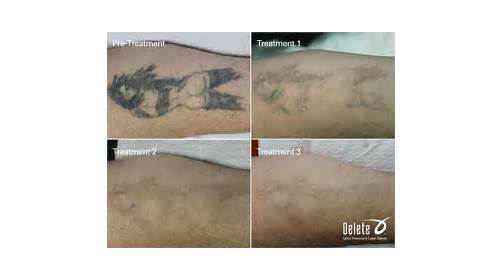 Explore morel mushroom tattoo ideas, creative tattoo ideas in Phoenix, available at Removery Tattoo Removal & Fading