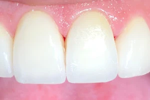 Dr Georgel Camille - Dentiste Montpellier - Implantologue - Implant dentaire - parodontie - facettes esthétiques image