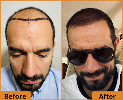 UK Hair Transplant Clinics Chelmsford - UK Hair Transplant Clinics Chelmsford