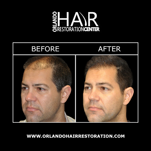 Hair Replacement Service «Orlando Hair Restoration Center», reviews and photos, 422 S Alafaya Trail Suite 32A, Orlando, FL 32828, USA