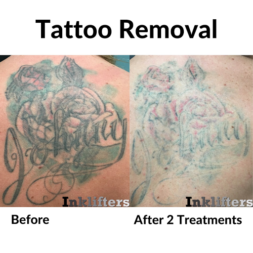 Explore lace tattoo ideas, creative tattoo ideas in Pleasant Grove, available at Inklifters Tattoo Removal