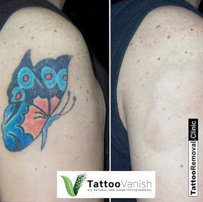 Tattoo Removal Clinic | Brampton