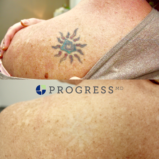 Explore muscle tattoo ideas, creative tattoo ideas in Amarillo, available at Progress MD Tattoo Removal