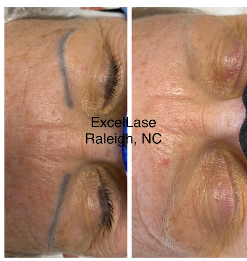 Explore cute butterfly tattoo ideas, creative tattoo ideas in Raleigh, available at ExcelLase