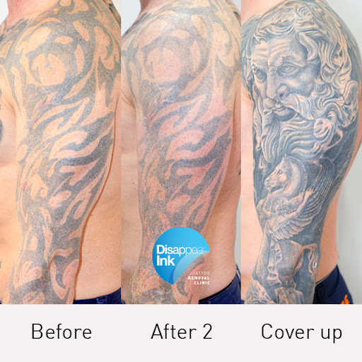 Disappear Ink Tattoo Removal Clinic