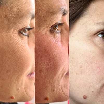 Miss Dalya Beauty - Microneedling | Hydra-beauté | Hyaluron Pen | Lifting Colombien à Athis-Mons