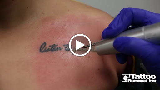 Explore tattoo ideas on rib cage, creative tattoo ideas in South Gate, available at Tattoo Removal Inc