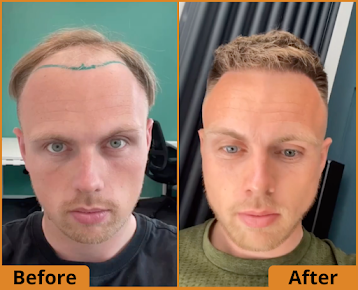 UK Hair Transplant Clinics Chelmsford - UK Hair Transplant Clinics Chelmsford