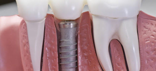Arrowhead Family Dental and Dentures