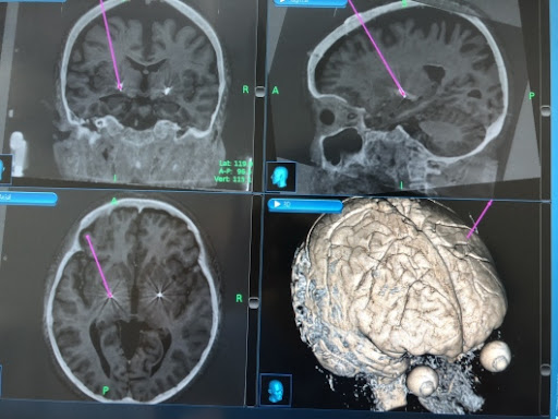 Dr. Juan Carlos Benedetti Isaac, Neurocirujano