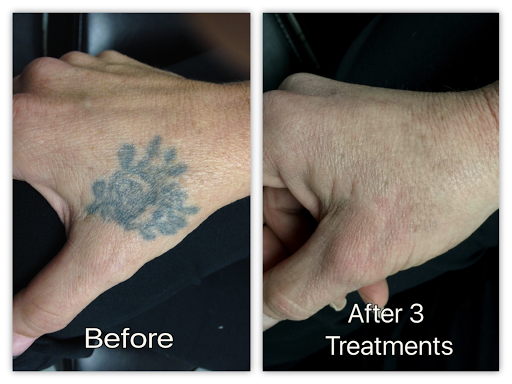 Explore tattoo ideas gangster, creative tattoo ideas in Honolulu, available at Removery Tattoo Removal & Fading
