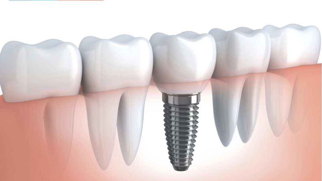 Dentistes/ implants dentaires/ le bourget à Le Bourget