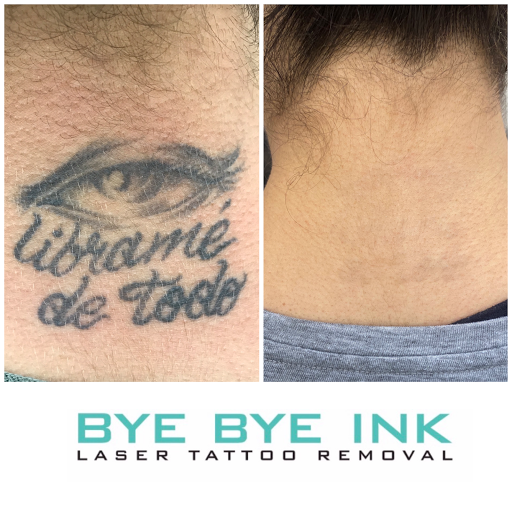 Explore full neck tattoo ideas, creative tattoo ideas in Middle Village, available at Bye Bye Ink Laser Tattoo Removal