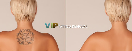 VIP Tattoo Removal - Las Vegas