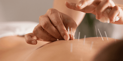 Acupuncture in New York @ Nyhealers