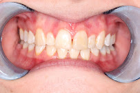 Dental Implant Perth