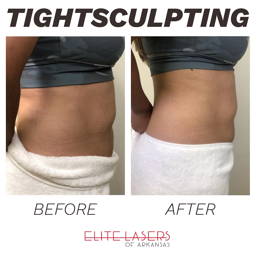 Elite Lasers of Arkansas 72758