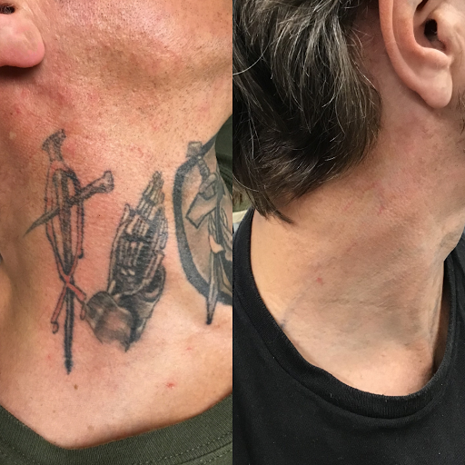 Explore men's side neck tattoo ideas, creative tattoo ideas in Milwaukee, available at Removery Tattoo Removal & Fading