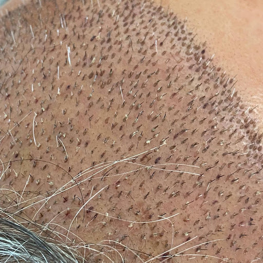 Ziering Medical Hair Restoration Beverly Hills image