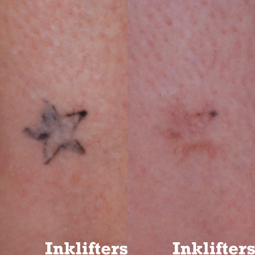 Explore aries tattoo ideas male, creative tattoo ideas in Pleasant Grove, available at Inklifters Tattoo Removal