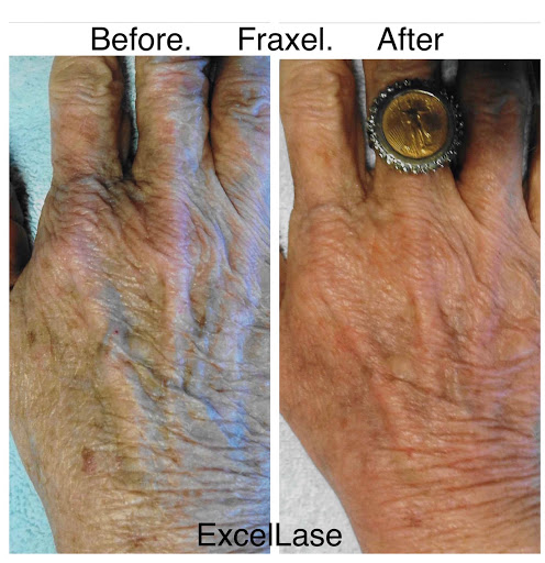 Explore small henna tattoo ideas, creative tattoo ideas in Raleigh, available at ExcelLase