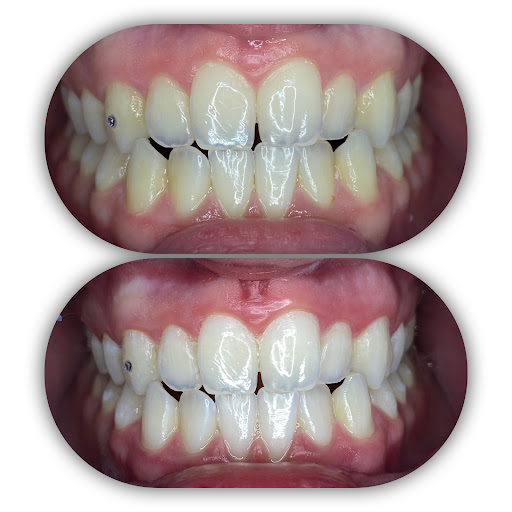 First Impressions Teeth Whitening