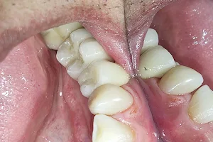 Bio Implantes - Estética Biomimética e Reabilitação Oral-Clínica Odontológica no Bessa/Intermares- João Pessoa e Cabedelo image