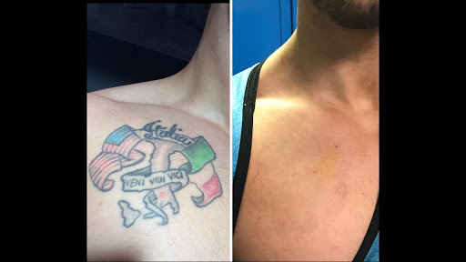 Ink On Ink Off Offering Safe and Effective Laser Tattoo Removal 2 AF1QipNHDOZZ2gS7n2hg4KFAmYd3nzygvXke4gk b3Qz